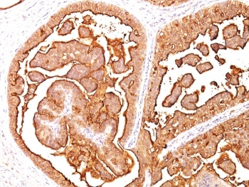 IHC analysis of formalin-fixed, paraffin-embedded human breast carcinoma stained with MUC1 antibody (clone E29).