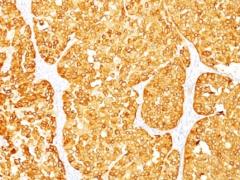 Melan-A Antibody Cocktail Immunohistochemistry. IHC: Formalin-fixed, paraffin-embedded human melanoma stained with MART-1 / Melan-A antibody (M2-7C10 + M2-9E3).