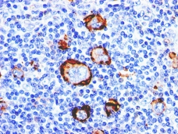 CD15 Antibody Hodgkin's Lymphoma IHC. Immunohistochemistry analysis of FFPE human Hodgkin's lymphoma tissue stained with CD15 Antibody demonstrates strong membranous and cytoplasmic HRP-DAB brown staining within large Reed-Sternberg-like neoplastic cellular populations against a background of reactive inflammatory infiltrates. This leukocyte differentiation antigen antibody highlights CD15 / Lewis X-associated glycosylation patterns characteristic of Hodgkin lymphoma-associated tumor cells and hematopathology-related immune differentiation pathways.