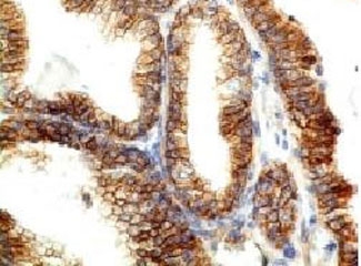 E-cadherin Antibody Colon Carcinoma IHC. Immunohistochemistry analysis of Cadherin 1 / CDH1 expression in FFPE human colon carcinoma using HuProt specificity validated clone CDH1/1525 antibody, showing membranous HRP-DAB brown staining in tumor epithelial cells with preserved cell-cell junction localization, while surrounding stromal components remain largely negative. Signal highlights epithelial differentiation and junctional organization within carcinoma tissue.