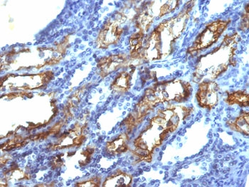 IFN gamma Antibody RCC IHC. Immunohistochemistry testing of FFPE human renal cell carcinoma with IFN gamma antibody (clone IFNG/466). Required HIER: boil tissue sections in 10mM Tris with 1mM EDTA, pH 9.0, for 10-20 min.
