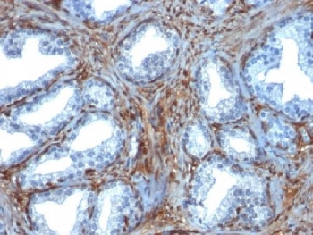 Galectin 1 Antibody Prostate Carcinoma IHC. Immunohistochemical staining of FFPE human prostate carcinoma tissue using Galectin 1 antibody (clone GAL1/1831) demonstrates strong cytoplasmic and stromal-associated HRP-DAB brown staining within the tumor microenvironment. Prominent immunoreactivity is observed in spindle-shaped stromal cells surrounding malignant glandular structures, consistent with the known expression pattern of Galectin-1 (LGALS1), a beta-galactoside-binding lectin involved in immune regulation, extracellular matrix remodeling, angiogenesis, and tumor progression. The staining pattern highlights both stromal and tumor-associated compartments and supports the use of clone GAL1/1831 for detection of Galectin-1 expression in FFPE tissue specimens. HIER: boil tissue sections in 10mM citrate buffer, pH 6, for 10-20 min.