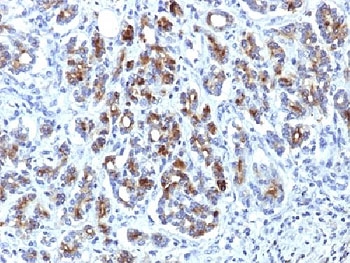 Alpha-1-Antichymotrypsin Antibody Pancreas IHC. Immunohistochemistry of Alpha-1-antichymotrypsin / SERPINA3 in FFPE human pancreas using a mouse monoclonal Alpha-1-antichymotrypsin antibody, clone AACT/1451. Cytoplasmic HRP-DAB brown staining is observed in glandular epithelial cells and scattered stromal or immune-associated cells, consistent with secreted protein localization and inflammatory component involvement, while nuclei are counterstained blue. Antigen retrieval was performed by steaming sections in pH 6 10 mM citrate buffer for 10â20 min prior to staining.