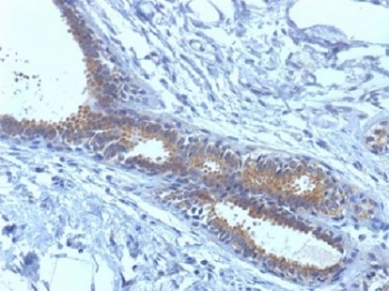 BRCA1 Antibody Breast Carcinoma IHC. Immunohistochemistry analysis of FFPE human breast carcinoma tissue using BRCA1 antibody clone BRCA1/1398. Tumor epithelial cells demonstrate predominantly nuclear HRP-DAB brown staining consistent with the chromatin-associated localization of BRCA1 in hereditary breast cancer-associated DNA repair, homologous recombination signaling, and genomic stability maintenance pathways, while surrounding stromal regions show comparatively lower signal intensity. Nuclei are counterstained blue. Heat-induced epitope retrieval was performed by boiling tissue sections in Tris-EDTA buffer, pH9.