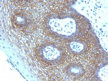 CD44v4 Antibody for IHC Cervical Squamous Cell Carcinoma. Immunohistochemistry analysis of CD44 variant 4 / CD44 expression in FFPE human cervical squamous cell carcinoma using mouse monoclonal antibody clone CD44v4/1219. Strong membranous HRP-DAB brown staining is observed in malignant squamous epithelial cells forming tumor nests, clearly outlining cell borders and preserving epithelial organization consistent with CD44v4-associated squamous differentiation and carcinoma identity. The staining pattern highlights cohesive tumor architecture and supports its use as a marker of epithelial lineage and structural integrity in squamous cell carcinoma. Heat induced epitope retrieval was performed by steaming tissue sections in pH 9 10mM Tris with 1mM EDTA buffer for 10-20 min.