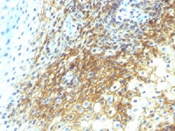 CD44v4 Antibody for IHC Tongue Squamous Cell Carcinoma. Immunohistochemistry analysis of CD44 variant 4 / CD44 expression in FFPE human tongue squamous cell carcinoma using mouse monoclonal antibody clone CD44v4/1219. Membranous HRP-DAB brown staining is observed in malignant squamous epithelial cells, outlining tumor cell borders and highlighting areas of cohesive and less organized growth consistent with CD44v4-associated squamous differentiation and carcinoma identity. The staining pattern supports its use as a marker of epithelial lineage and tumor architecture in squamous cell carcinoma of the tongue. Heat induced epitope retrieval was performed by steaming tissue sections in pH 9 10mM Tris with 1mM EDTA buffer for 10-20 min.
