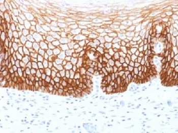CD44v9 Antibody for IHC Tumor Tissue Cervical Carcinoma. Immunohistochemistry analysis of CD44 variant 9 / CD44 expression in FFPE human cervical carcinoma using mouse monoclonal antibody clone CD44v9/1459. Strong membranous HRP-DAB brown staining is observed in malignant epithelial cells, clearly outlining tumor nests and highlighting cell surface localization consistent with CD44v9-associated cell adhesion and tumor progression biology. The staining pattern demonstrates uniform expression across carcinoma regions, supporting its use in evaluating epithelial tumor organization and disease-related changes in tissue architecture. Heat induced epitope retrieval was performed by steaming tissue sections in pH 9 10mM Tris with 1mM EDTA buffer for 10-20 min.