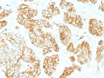 CD44v9 Antibody for IHC Tumor Tissue Prostate Carcinoma. Immunohistochemistry analysis of CD44 variant 9 / CD44 expression in FFPE human prostate carcinoma using mouse monoclonal antibody clone CD44v9/1459. Distinct membranous HRP-DAB brown staining is observed in malignant epithelial cells forming glandular structures, highlighting cell surface localization consistent with CD44v9-associated adhesion and tumor progression biology. The staining pattern demonstrates heterogeneous distribution across tumor glands, supporting its relevance for evaluating epithelial tumor organization and progression-associated changes within prostate carcinoma tissue. Heat induced epitope retrieval was performed by steaming tissue sections in pH 9 10mM Tris with 1mM EDTA buffer for 10-20 min.