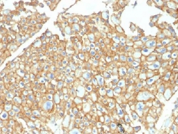 EpCAM Antibody Human Renal Cell Carcinoma IHC. Immunohistochemistry testing of FFPE human renal cell carcinoma and EpCAM antibody. Required HIER: steam sections in pH6 citrate buffer for 10-20 min.