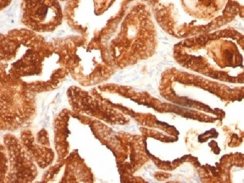 PAP Antibody immunohistochemistry analysis of Prostatic acid phosphatase / ACP3 in human prostate carcinoma tissue. FFPE human prostate carcinoma tissue was stained with PAP Antibody (mouse monoclonal, clone SPM312). Heat induced epitope retrieval was performed by boiling tissue sections in pH 9 Tris-EDTA buffer (10mM Tris, 1mM EDTA) for 10-20 minutes followed by cooling at room temperature prior to staining. HRP-DAB brown chromogenic signal highlights strong cytoplasmic staining of prostate tumor epithelial cells forming glandular carcinoma structures, consistent with the known localization of Prostatic acid phosphatase (ACP3 / PAP) in prostate-derived epithelial cells. Detection of PAP expression by immunohistochemistry is widely used in prostate cancer research and prostate pathology studies to identify prostate epithelial lineage and evaluate Prostatic acid phosphatase expression in prostate carcinoma tissues.