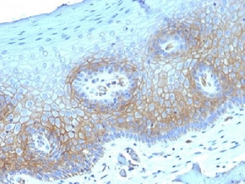 Thrombomodulin Antibody / Protein C Pathway Receptor. Immunohistochemistry analysis of Thrombomodulin / THBD expression in human cervical carcinoma using clone THBD/1782. FFPE tumor tissue shows membranous HRP-DAB brown staining in tumor epithelial cells with additional staining of endothelial cells lining vascular structures, consistent with the known localization of thrombomodulin as a protein C pathway receptor in vascular endothelium. Antigen retrieval was performed by boiling sections in 10mM Tris buffer with 1mM EDTA, pH 9, for 10-20 minutes followed by cooling at room temperature.