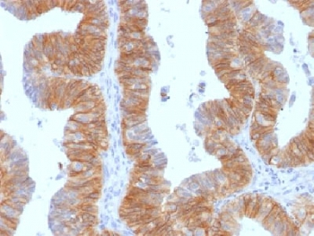 EpCAM Antibody Ovarian Carcinoma IHC. Immunohistochemistry testing of FFPE human ovarian carcinoma and EpCAM antibody (clone EGP40/1384). Required HIER: steam sections in pH6 citrate buffer for 10-20 min.