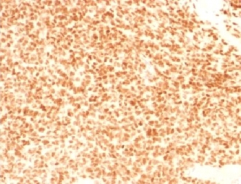 IHC testing of FFPE Ewings sarcoma with NKX2.2 antibody (clone NX2/1524). HIER: steam sections in 10mM citrate buffer, pH 6, for 10-20 min.