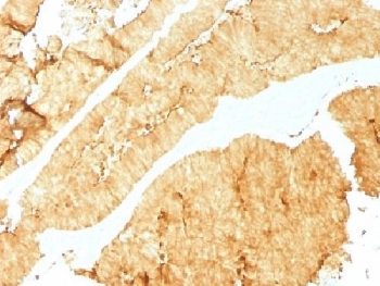 Villin Antibody. Immunohistochemistry analysis of Villin-1 (VIL1) in FFPE human colon using Villin Antibody / Epithelial Tumor Marker Antibody with mouse monoclonal clone VIL1/1325. Strong HRP-DAB brown staining is observed in epithelial cells with prominent membranous and apical localization, highlighting glandular structures characteristic of colorectal tissue. The staining pattern supports identification of epithelial tumor cells and reinforces Villin as an epithelial tumor marker associated with gastrointestinal malignancies, including colorectal cancer.