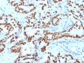 FOXA1 Antibody Human Prostate Carcinoma IHC. Immunohistochemical staining of FFPE human prostate carcinoma tissue using FOXA1 Antibody (clone FOXA1/1519) demonstrates strong nuclear HRP-DAB brown staining throughout malignant epithelial cell populations. The staining pattern is consistent with expression of FOXA1, a forkhead family transcription factor that functions as a developmental regulator of gene expression, epithelial differentiation, and tissue-specific transcriptional programs. The prominent nuclear localization is characteristic of a DNA-binding transcription factor and supports the role of FOXA1 in maintaining epithelial lineage identity and regulating gene networks associated with cellular differentiation, tissue development, and organ-specific function. HIER: boil sections in 10 mM Tris with 1 mM EDTA, pH 9, for 10-20 minutes prior to staining.