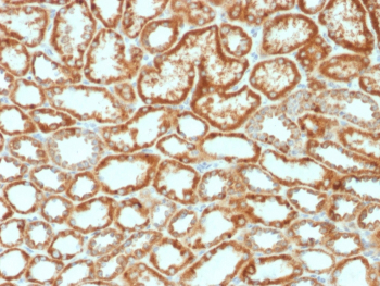 EPO Antibody Renal Cell Carcinoma IHC. Immunohistochemistry analysis of FFPE human renal cell carcinoma tissue using EPO Antibody demonstrates HRP-DAB brown cytoplasmic staining in tumor epithelial cells lining renal tubular structures, consistent with erythropoietin (EPO) expression as a hypoxia response hormone, while surrounding stromal elements show lower signal; nuclei are counterstained blue. HIER: boil tissue sections in pH 6 10 mM citrate buffer for 10-20 min followed by cooling at room temperature for 20 min.