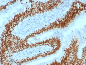 IHC testing of FFPE human lung carcinoma with SOX2 antibody (clone SOX2/1792). Required HIER: boil tissue sections in 10mM citrate buffer, pH 6, for 10-20 min followed by cooling at RT for 20 min.
