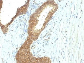 Alkaline Phosphatase Tissue Non Specific Antibody Colon Carcinoma IHC. Immunohistochemistry analysis of FFPE human colon carcinoma tissue stained with Alkaline Phosphatase Tissue Non Specific Antibody (clone ALPL/597). This ALPL IHC antibody demonstrates strong granular cytoplasmic and membranous HRP-DAB brown staining in malignant gland-forming epithelial cells, while surrounding stromal tissue shows minimal background reactivity. The staining profile is consistent with expression of alkaline phosphatase, tissue-nonspecific isozyme / ALPL within differentiated colorectal tumor epithelium. Required HIER: boil tissue sections in 10mM Tris with 1mM EDTA, pH 9, for 10-20 min followed by cooling at RT for 20 min.