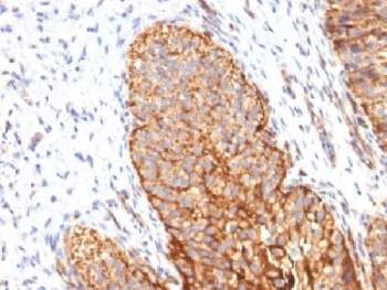 Thrombomodulin Antibody / Tumor Vascular Marker. Immunohistochemistry analysis of Thrombomodulin / THBD expression in human bladder carcinoma using clone THBD/1591. FFPE tumor tissue shows membranous HRP-DAB brown staining in tumor epithelial cells with additional staining of endothelial cells forming tumor-associated vascular structures, highlighting tumor vasculature within the tumor microenvironment. Antigen retrieval was performed by boiling sections in 10mM Tris buffer with 1mM EDTA, pH 9, for 10-20 minutes followed by cooling at room temperature.