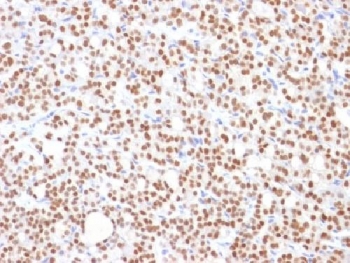 PAX8 Antibody Clone PAX8/1492 / Paired Box Protein Pax-8 Antibody immunohistochemistry in human thyroid carcinoma tissue showing strong nuclear staining consistent with PAX8 expression in tumor epithelial cells. The mouse monoclonal antibody clone PAX8/1492 demonstrates clear nuclear localization, aligning with the role of Paired box protein Pax-8 (PAX8) as a lineage-specific transcription factor in thyroid-derived malignancies. Staining highlights dense tumor cell populations with expected nuclear positivity, supporting its utility as a thyroid lineage marker in carcinoma samples. Required HIER: boil tissue sections in 10mM Tris buffer with 1mM EDTA, pH 9, for 10-20 min followed by cooling at RT for 20 minutes.