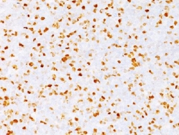 TOP2A Antibody Bladder Cancer IHC. Immunohistochemistry testing of FFPE human bladder carcinoma with TOP2A antibody (clone TOP2A/1362). Required HIER: boil sections in pH 9 10mM Tris with 1mM EDTA for 10-20 min followed by cooling at RT for 20 min.