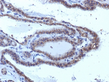 IHC testing of FFPE human thyroid carcinoma with TSHR antibody (clone SPM223). Required HIER: boil tissue sections in 10mM Tris with 1mM EDTA, pH 9, or 10mM citrate buffer, pH 6, for 10-20 min followed by cooling at RT for 20 min.