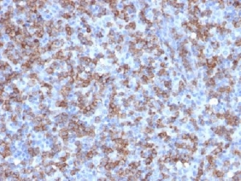 CD8A Antibody Lymphoma IHC. Immunohistochemistry analysis of CD8 alpha (CD8A) in FFPE human lymphoma tissue shows strong membranous staining of infiltrating cytotoxic T lymphocytes within the tumor microenvironment, consistent with CD8A expression as a cytotoxic T cell marker and supporting identification of effector T cell populations in lymphoid malignancy. Heat-induced epitope retrieval was performed in 10 mM citrate buffer, pH 6.0, for 10-20 minutes followed by cooling at room temperature.
