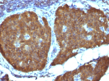Neuron Specific Enolase Antibody Human Pheochromocytoma IHC. testing of FFPE human pheochromocytoma with Neuron Specific Enolase antibody (clone ENO2/1462). Required HIER: boil sections in 10mM citrate buffer, pH6, for 10-20 min.