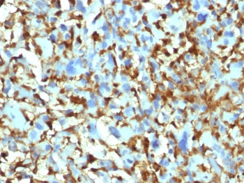 Immunohistochemistry of Factor XIIIa antibody in human histiocytoma. FFPE human histiocytoma tissue was stained with human protein microarray validated Factor XIIIa antibody clone F13A1/1448. Strong cytoplasmic HRP-DAB brown staining is observed in numerous spindle-shaped and histiocytic tumor cells, consistent with known Factor XIII A chain expression in fibrohistiocytic lesions. Background stromal elements show minimal staining. Heat induced epitope retrieval was performed by boiling tissue sections in 10 mM citrate buffer, pH 6, for 10-20 minutes prior to antibody incubation.