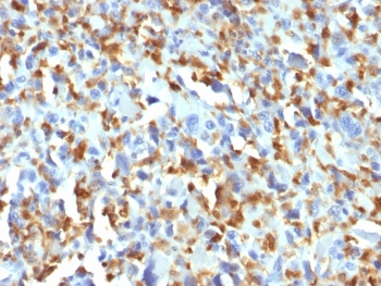 Immunohistochemistry of Factor XIIIa antibody in human histiocytoma. FFPE human histiocytoma tissue was stained with human tissue array validated Factor XIIIa antibody clone F13A1/1683. Strong cytoplasmic HRP-DAB brown staining is observed in numerous spindle-shaped and histiocytic tumor cells, consistent with known Factor XIII A chain expression in fibrohistiocytic lesions. Surrounding stromal elements show minimal to absent staining. Heat induced epitope retrieval was performed by boiling tissue sections in 10 mM citrate buffer, pH 6, for 10-20 minutes prior to antibody incubation.