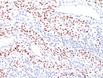 IHC: Formalin-fixed, paraffin-embedded human bladder carcinoma stained with TP53 antibody (TRP/816). Required HIER: boil tissue sections in 10mM Citrate buffer, pH 6.0, for 10-20 min followed by cooling at RT for 20 min.