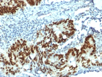p53 Antibody Clone PAb 1801 / TP53 Tumor Suppressor Antibody. Immunohistochemistry analysis of FFPE human colon carcinoma tissue demonstrates strong nuclear staining of tumor epithelial cells using p53 Antibody Clone PAb 1801. The HRP-DAB brown chromogenic signal highlights nuclear localization of Tumor protein p53 within malignant epithelial cells, while surrounding stromal cells show comparatively weaker staining. Heat-induced epitope retrieval was performed by boiling tissue sections in 10 mM citrate buffer (pH 6.0) for 10-20 minutes followed by cooling at room temperature for 20 minutes prior to staining.