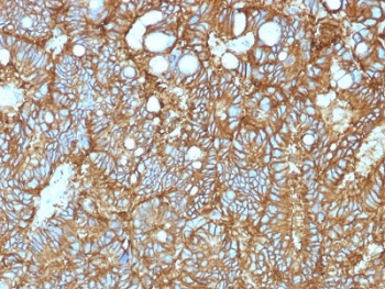 EpCAM Antibody Hepatocellular Carcinoma IHC. Immunohistochemistry staining of FFPE human hepatocellular carcinoma tissue using EpCAM Antibody / Epithelial Cell Marker Antibody (clone EGP40/1372) demonstrates strong membranous HRP-DAB brown staining throughout neoplastic epithelial cell populations. The staining pattern is consistent with expression of Epithelial Cell Adhesion Molecule (EPCAM/CD326), a cell surface glycoprotein involved in epithelial cell adhesion, tissue organization, and intracellular signaling. Prominent circumferential membrane staining highlights the epithelial phenotype of the tumor cells and is characteristic of EpCAM expression in epithelial-derived malignancies. Because EpCAM is frequently associated with epithelial differentiation and tumor cell populations, its detection is widely utilized in cancer research and tumor characterization studies. Required HIER: steam tissue sections in pH 9 Tris-EDTA buffer (10 mM Tris, 1 mM EDTA) for 10-20 minutes prior to staining.