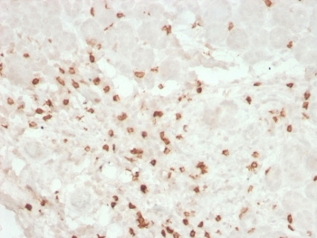 CD8A Antibody Colon IHC. Immunohistochemistry analysis of CD8 alpha (CD8A) in FFPE human colon tissue shows membranous staining of infiltrating cytotoxic T lymphocytes within the tissue microenvironment, consistent with CD8A expression on T cell surfaces and supporting identification of immune infiltration in epithelial tissues. HuProt microarray validated antibody performance supports specificity-focused detection in complex tissue samples (clone rC8/468). Heat-induced epitope retrieval was performed in pH 9 EDTA buffer for 10-20 minutes followed by cooling at room temperature.