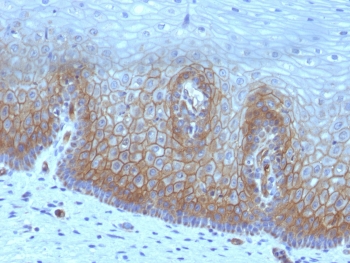 Thrombomodulin Antibody / Endothelial Cell Marker. Immunohistochemistry analysis of Thrombomodulin / THBD expression in human cervical carcinoma using clone rTHBD/1591. FFPE tissue sections show membranous HRP-DAB brown staining in tumor epithelial cells, with endothelial cell staining highlighting vascular structures within the tumor microenvironment. Antigen retrieval was performed by boiling sections in 10mM Tris buffer with 1mM EDTA, pH 9, for 10-20 minutes followed by cooling at room temperature.