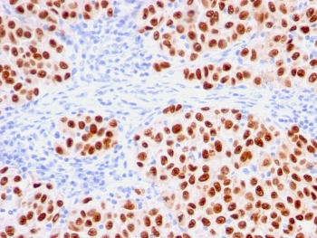 IHC testing of FFPE human melanoma with SRY-box 10/SOX10 antibody (clone rSOX10/1074). Required HIER: boil tissue sections in 10mM citrate buffer, pH 6, for 10-20 min followed by cooling at RT for 20 min.
