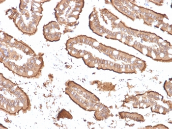 Villin Antibody. Immunohistochemistry analysis of Villin-1 (VIL1) in FFPE human small intestine carcinoma using Villin Antibody / Brush Border Cytoskeletal Protein Antibody with recombinant mouse monoclonal clone rVIL1/1325. Strong HRP-DAB brown staining highlights the apical membrane of tumor epithelial cells, outlining glandular and villus-like structures with a distinct luminal pattern consistent with brush border localization. The predominantly membranous apical signal emphasizes microvilli-associated staining and supports Villin as a brush border cytoskeletal protein in intestinal-type carcinoma.