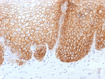 CD44v9 Antibody for IHC Cervical Cancer. Immunohistochemistry analysis of CD44 variant 9 / CD44 expression in FFPE human cervical carcinoma using recombinant mouse monoclonal antibody clone rCD44v9/1459. Strong membranous HRP-DAB brown staining is observed in malignant epithelial cells, outlining tumor nests and highlighting cell surface localization consistent with CD44v9-mediated adhesion and stress-adaptive signaling. The staining pattern supports its association with oxidative stress defense and survival of carcinoma cells within the tumor microenvironment. Heat induced epitope retrieval was performed by boiling tissue sections in pH 9 10mM Tris with 1mM EDTA for 10-20 min followed by cooling at RT for 20 min.