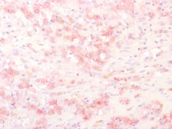 IHC testing of FFPE human melanoma with recombinant TRP1 antibody (clone TYPR1/2340R). Required HIER: boil tissue sections in pH 9 10mM Tris with 1mM EDTA for 10-20 min followed by cooling at RT for 20 min.
