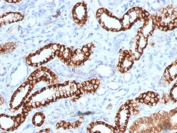 IHC testing of FFPE human renal cell carcinoma with Cadherin 16 antibody (clone rCDH16/1071). Required HIER: boil tissue sections in 10mM Tris with 1mM EDTA, pH 9, for 10-20 min followed by cooling at RT for 20 min.