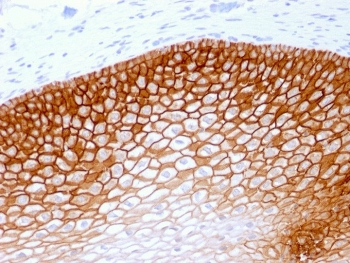 CD44v4 Antibody for IHC Cervical Squamous Cell Carcinoma. Immunohistochemistry analysis of CD44 variant 4 / CD44 expression in FFPE human cervical squamous cell carcinoma using recombinant mouse monoclonal antibody clone rCD44v4/1219. Strong membranous HRP-DAB brown staining is observed in malignant squamous epithelial cells forming cohesive sheets, clearly outlining cell borders and highlighting preserved epithelial organization consistent with CD44v4-associated tumor architecture and structural integrity. The staining pattern emphasizes uniform cell morphology and supports its use for evaluating epithelial structure and architectural organization within cervical carcinoma tissue. Heat induced epitope retrieval was performed by steaming tissue sections in pH 9 10mM Tris with 1mM EDTA buffer for 10-20 min.