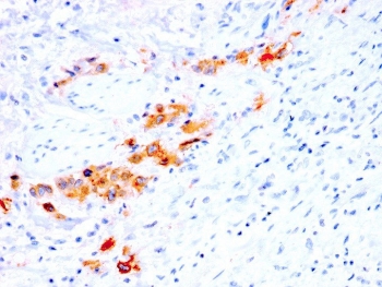CD44v4 Antibody for IHC Bladder Tissue. Immunohistochemistry analysis of CD44 variant 4 / CD44 expression in FFPE human bladder tissue using recombinant mouse monoclonal antibody clone rCD44v4/1219. Membranous HRP-DAB brown staining is observed in epithelial cells lining glandular and luminal structures, highlighting cell borders and demonstrating focal epithelial organization within the surrounding stroma consistent with CD44v4-associated tissue architecture. The staining pattern emphasizes structural variation and supports its use for evaluating epithelial morphology and organization in bladder tissue. Heat induced epitope retrieval was performed by steaming tissue sections in pH 9 10mM Tris with 1mM EDTA buffer for 10-20 min.