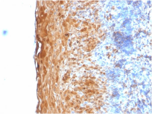 Involucrin Antibody IVRN/2113R in Human Tonsil IHC. Immunohistochemistry testing of FFPE human tonsil tissue with Involucrin Antibody clone IVRN/2113R. Staining of formalin-fixed tissue is enhanced by digestion with Trypsin or Protease XXV at 1 mg/ml PBS for 5 min at 37oC, which is more effective than citrate buffer-based epitope unmasking for this antibody. Strong brown cytoplasmic staining is concentrated throughout the differentiated suprabasal squamous epithelium, while the adjacent lymphoid tissue shows comparatively little signal. This differentiation-associated epithelial pattern demonstrates detection of involucrin using the IVL Monoclonal Antibody.