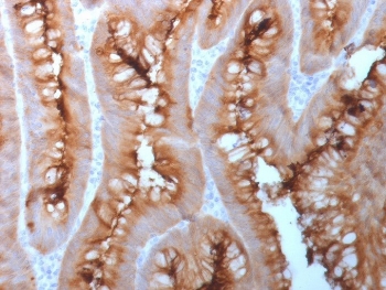 CEA Antibody Human Colon Carcinoma Tissue IHC. Immunohistochemistry analysis of CEA / CEACAM5 expression in FFPE human colon carcinoma using recombinant rabbit monoclonal antibody clone C66/1983R. This CEA antibody demonstrates strong apical membranous and luminal HRP-DAB brown staining in tumor epithelial cells forming glandular structures, with additional cytoplasmic signal, while surrounding stromal components remain largely negative; nuclei are counterstained blue. The staining pattern is consistent with the known epithelial localization of carcinoembryonic antigen in colorectal carcinoma.
