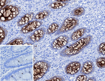 CEA Antibody Colon Carcinoma IHC. Immunohistochemistry analysis of CEA / CEACAM5 expression in FFPE human colon carcinoma using CEA antibody clone C66/1983R. Tumor epithelial cells show strong membranous and cytoplasmic HRP-DAB brown staining with glandular distribution, while surrounding stromal cells remain largely negative; nuclei are counterstained blue. Inset shows a PBS-only negative control processed without primary antibody, confirming minimal non-specific background staining.