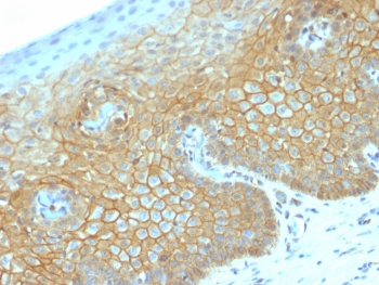 Beta-Catenin Antibody Cervical Carcinoma IHC. Immunohistochemistry of human cervical carcinoma using Beta-Catenin Antibody (clone CTNNB1/2030R) demonstrates strong membranous and cytoplasmic staining in tumor epithelial cells, consistent with CTNNB1 / Catenin beta-1 expression in adherens junctions, with focal areas suggesting increased cytoplasmic accumulation. Nuclear counterstain highlights tissue architecture, and stromal regions show comparatively minimal signal. This staining pattern reflects the dual role of beta-catenin in cell adhesion and Wnt signaling-associated redistribution. HIER: boil FFPE tissue sections in 10 mM citrate buffer, pH 6, for 10-20 min followed by cooling at RT for 20 min.