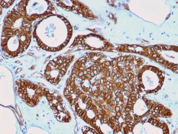 Beta-Catenin Transcriptional Marker Breast Carcinoma IHC. Immunohistochemistry analysis of human breast carcinoma using Beta-Catenin Antibody (clone rCTNNB1/2173) reveals strong cytoplasmic and membranous staining in tumor epithelial cells, consistent with CTNNB1 / Catenin beta-1 localization, with focal regions showing increased intracellular distribution relative to junctional staining. This pattern is consistent with beta-catenin redistribution observed during Wnt pathway activation and transcriptional signaling. Neoplastic glandular structures are well defined, while adjacent stromal components display comparatively low background staining. Hematoxylin counterstain provides clear nuclear contrast and architectural context. HIER: boil FFPE tissue sections in 10 mM Tris with 1 mM EDTA, pH 9, for 10-20 min followed by cooling at RT for 20 min.