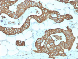 Immunohistochemistry analysis of KRT19 / Keratin 19 antibody (clone KRT19/1959R) in human colon tissue. Formalin-fixed, paraffin-embedded human colon tissue was stained using recombinant KRT19 / Keratin 19 antibody (clone KRT19/1959R). Heat-induced epitope retrieval was performed by boiling tissue sections in 10 mM Tris with 1 mM EDTA, pH 9.0, for 10-20 minutes, followed by cooling at room temperature prior to antibody incubation. Brown chromogenic signal is observed in glandular epithelial cells lining colonic crypts, with strong cytoplasmic and membranous staining outlining epithelial structures, while surrounding stromal and adipose tissue shows little to no staining. This staining pattern reflects epithelial-associated expression of Keratin 19 in colonic epithelium.