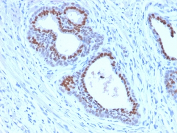 FOXA1 Antibody Human Tonsil IHC. Immunohistochemical staining of FFPE human tonsil tissue using FOXA1 Antibody / Developmental Transcription Factor Antibody (clone FOXA1/2230R) demonstrates strong nuclear HRP-DAB brown staining within epithelial cell populations lining glandular and crypt-associated structures. The staining pattern is consistent with expression of FOXA1, a forkhead family transcription factor that regulates developmental gene expression, epithelial differentiation, and tissue-specific transcriptional programs. The predominantly nuclear localization is characteristic of a DNA-binding transcriptional regulator and supports the role of FOXA1 in maintaining epithelial cellular identity and differentiated tissue phenotypes. HIER: boil sections in 10 mM Tris with 1 mM EDTA, pH 9 for 10-20 minutes followed by cooling at room temperature for 20 minutes.