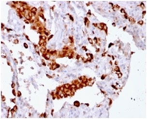 NAPSA Antibody for IHC. Immunohistochemistry analysis of Napsin A (NAPSA) expression in FFPE human lung adenocarcinoma demonstrates strong granular cytoplasmic HRP-DAB brown staining in tumor epithelial cells with minimal background in surrounding stromal regions. Clone rNAPSA/1239 highlights intracellular localization of Napsin A within vesicular compartments consistent with its role in secretory pathway protein trafficking and processing. HIER was performed by boiling tissue sections in pH 6 10mM citrate buffer for 10-20 minutes followed by cooling at RT for 20 minutes prior to staining.